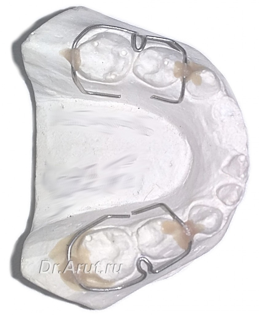 Кламмер Шварца (Schwarz) — Стоматология