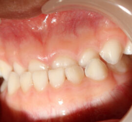 Мезиальный прикус