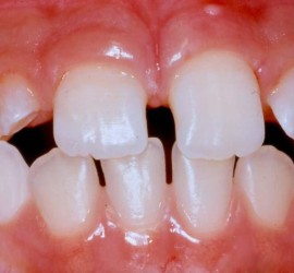 Микродентия