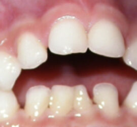 Открытый прикус