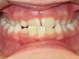 Перекрёстный прикус