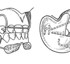 Регулятор функций Френкеля, а — FR тип I; б — FR тип III.