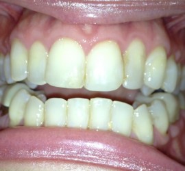 Ретропозиция зубов