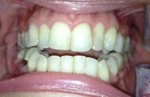 Ретропозиция зубов