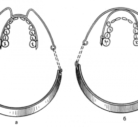 Скользящая дуга Энгля с внеротовой тягой