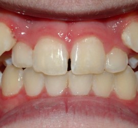 Супрапозиция клыков