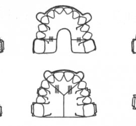 Съемные пластинки с секторальными распилами для удлинения зубного ряда