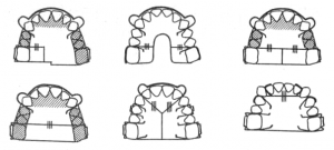 Съемные пластинки с секторальными распилами для удлинения зубного ряда