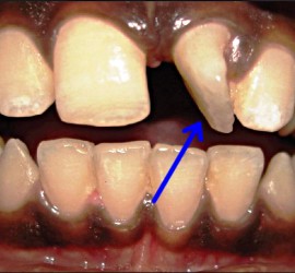 Тортопозиция зуба
