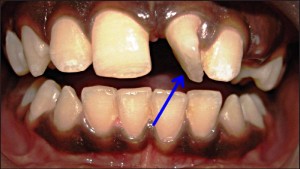 Тортопозиция зуба