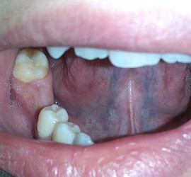 Вторичная адентия