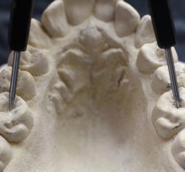 Индкес Пона в области моляра