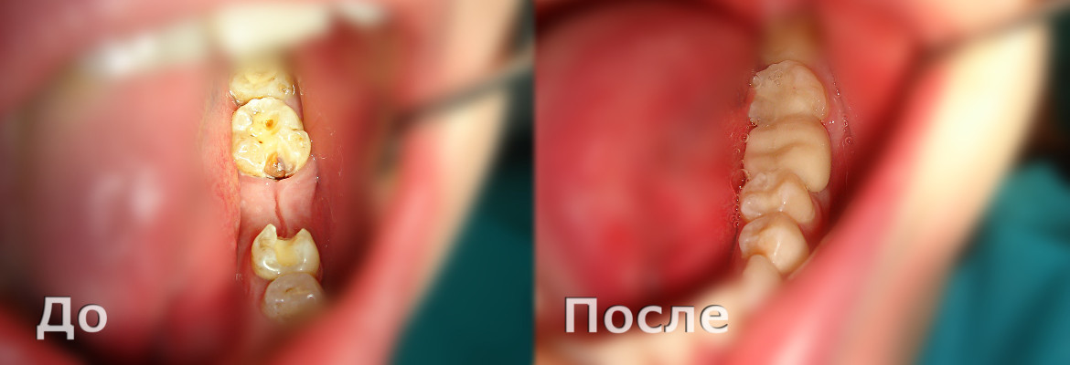 Адгезивный мостовидный протез