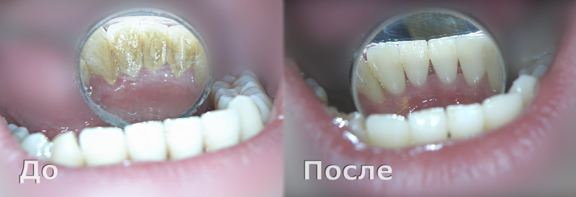 Удаление зубных отложений