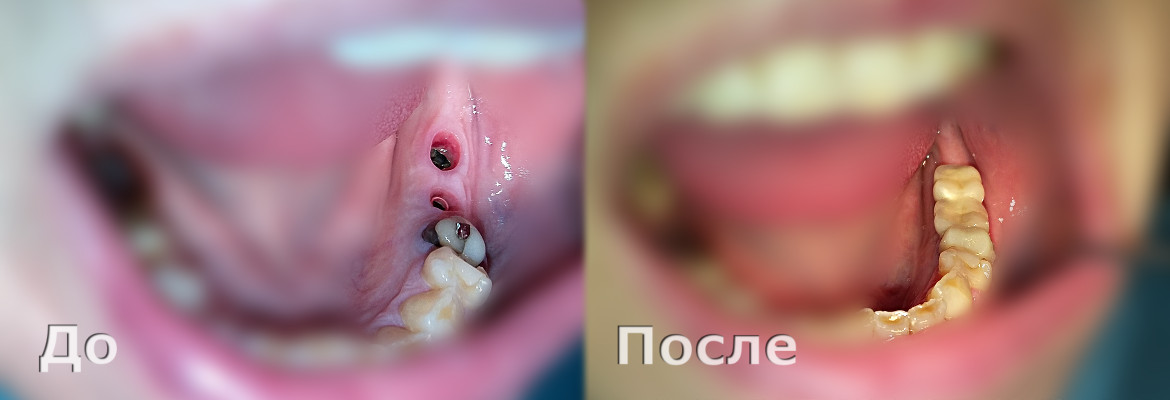 Протезирование на имплантатах