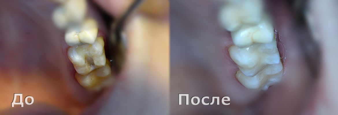 Керамическая вкладка