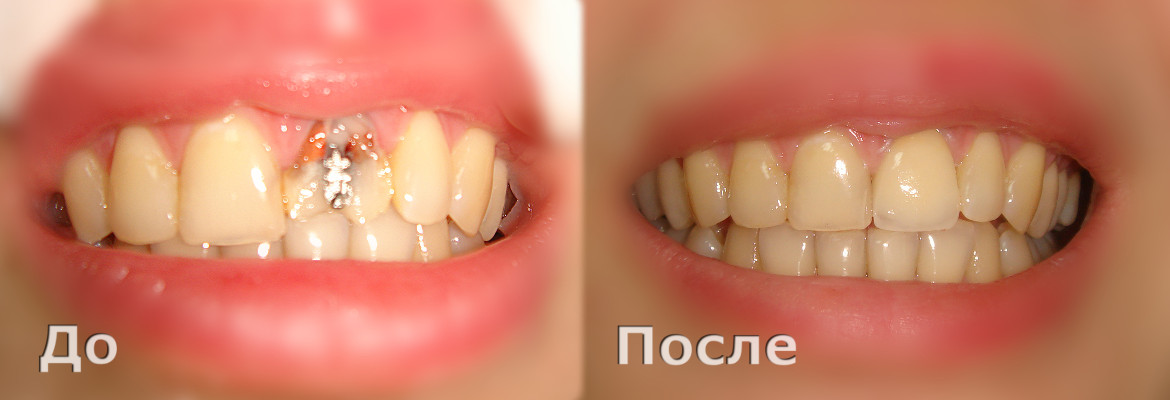 Металлокерамическая коронка