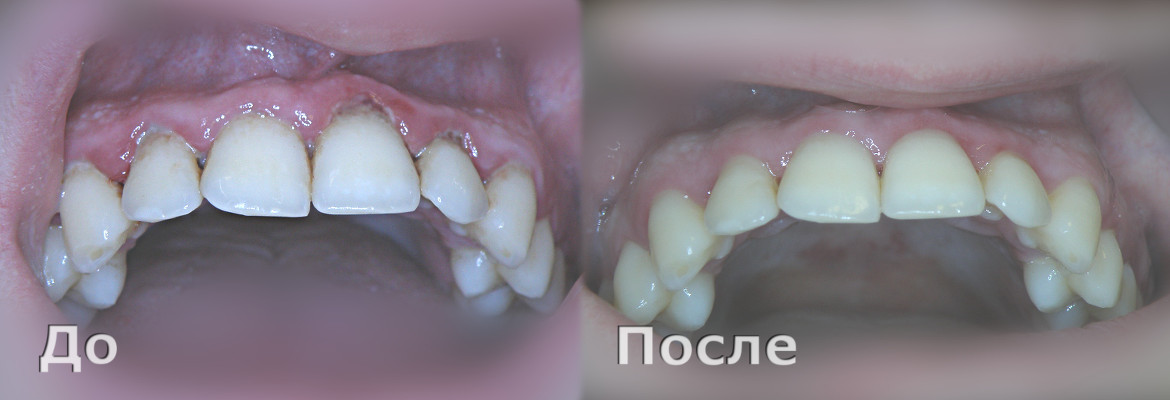 Лечение пародонтита