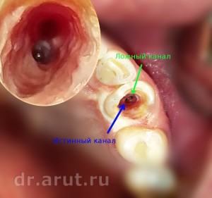 Истинный и ложный канал в клыке