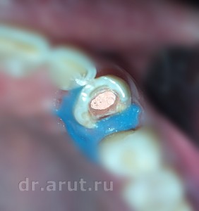 Пломбирование канала силером с гуттаперчей