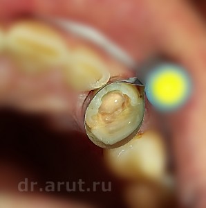 Восстановление зуба композитом