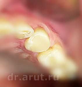 Зуб восстановлен композитом
