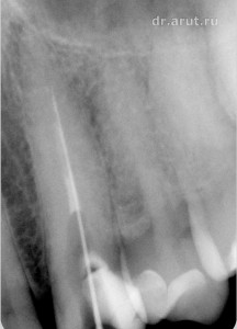 Хронический периодонтит