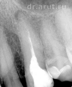 Хронический периодонтит