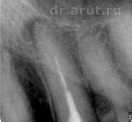 Хронический периодонтит в стадии обострения