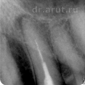 Хронический периодонтит в стадии обострения