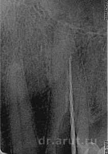 Распломбирование канала