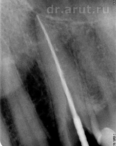 Прохождение канала на всю длину