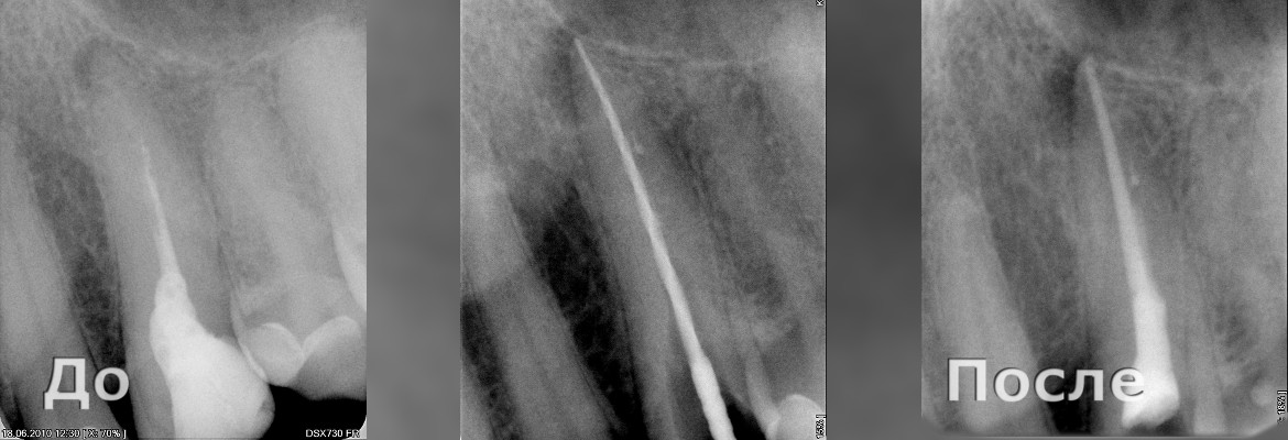 Лечение периодонтита