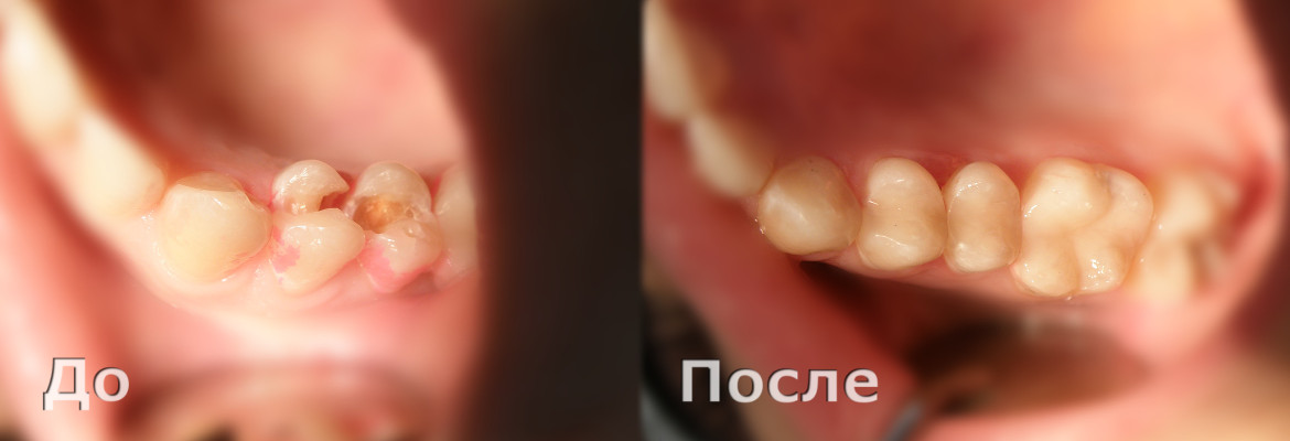 Пломбирование зубов