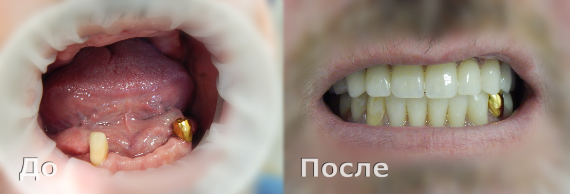 Полная потеря зубов