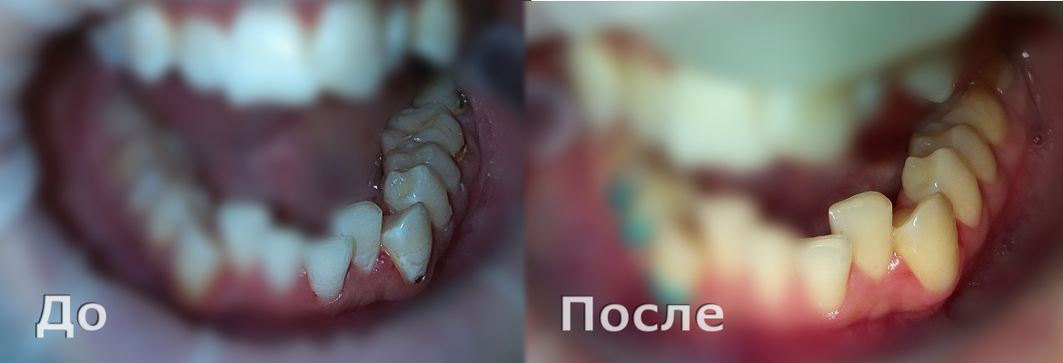 Лечение пришеечного кариеса