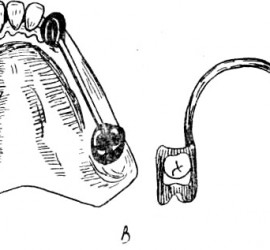 Съёмный мостовидный протез с бюгелем
