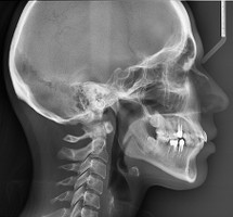 Телерентгенограмма головы