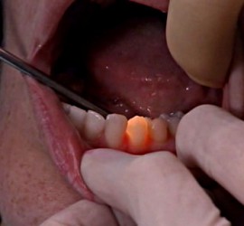 Трансиллюминационный метод