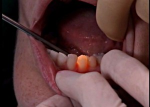 Трансиллюминационный метод