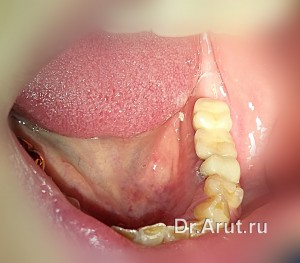 Фиксация коронок на имплантат