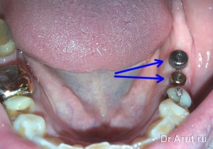 Установка формирователей десны