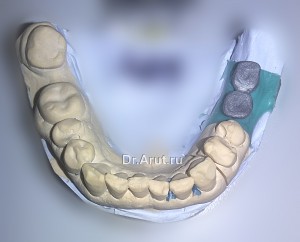 Припасованный каркас на абатменте