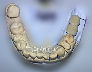 Коронки на модели