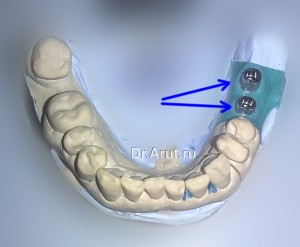 Отлитая модель с аналогом и абатментом