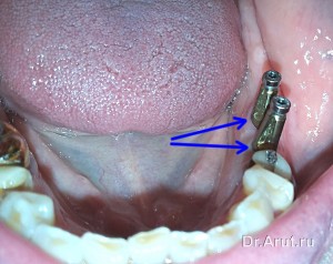 Установка трансферов для закрытой ложки