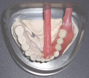 Восковые литники