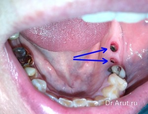 Вскрытие имплантата