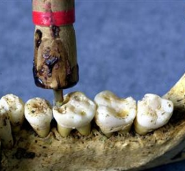 Сверление зуба луковой дрелью