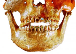 Инкрустация камней в зубы